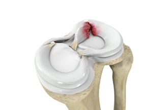 Study suggests surgery better than observation for older patients with meniscus tear